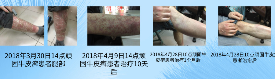 中医治疗银屑病