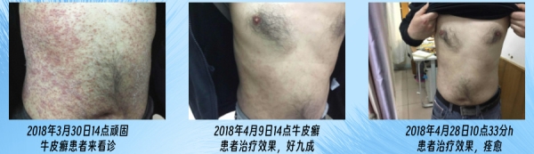 ‌中医治疗牛皮癣的综合方法