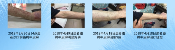 ‌中医治疗牛皮癣的方法