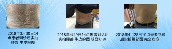 三汤一膏中医治疗牛皮癣